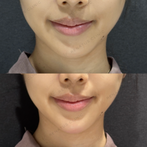 顎ヒアルロン酸ボラックス症例写真の症例写真