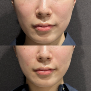 鼻翼基部ヒアルロン酸ボリフト症例写真の症例写真