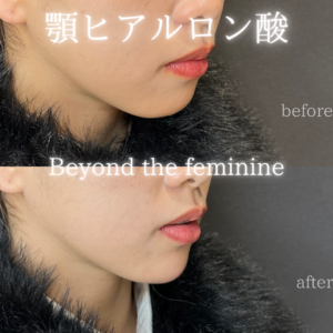 大阪梅田で顎ヒアルロン酸といえばレナトゥスクリニックの症例写真