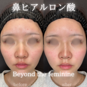 大阪梅田・心斎橋で鼻ヒアルロン酸ならレナトゥスクリニック大阪院の症例写真