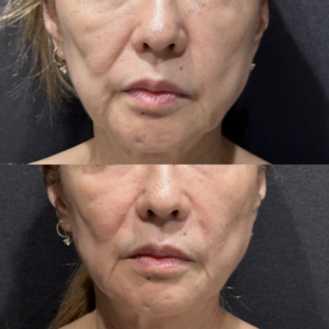 ゴルゴ頬こけほうれい線マリオネットヒアルロン酸ボリフト症例写真の症例写真