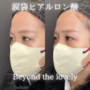 大阪梅田で涙袋ヒアルロン酸するならレナトゥスクリニック大阪院への症例写真