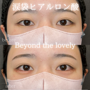 涙袋ヒアルロン酸が梅田・茶屋町で人気 レナトゥスクリニック大阪院の症例写真