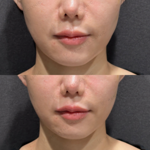 Cカールヒアルロン酸ボルベラ症例写真の症例写真