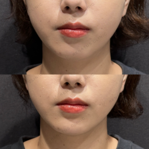 顎ヒアルロン酸ダイヤモンドフィール症例写真の症例写真