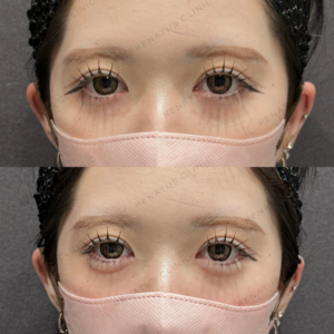 涙袋ヒアルロン酸ボルベラ症例写真の症例写真