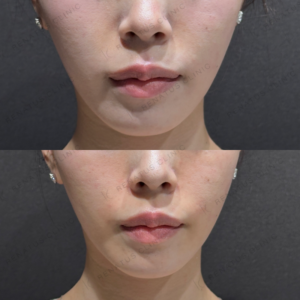 鼻翼基部ヒアルロン酸ボリューマ症例写真の症例写真