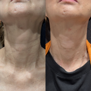 首ヒアルロン酸ボライト症例写真の症例写真