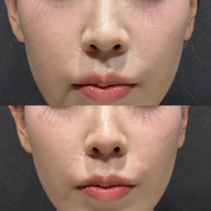 鼻中隔ヒアルロン酸ボラックス症例写真の症例写真