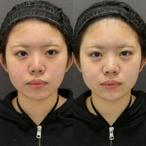 涙袋・顎ヒアルロン酸ボラックス症例写真の症例写真