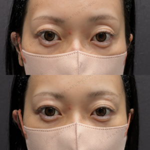 目の上ヒアルロン酸ボルベラ症例写真の症例写真