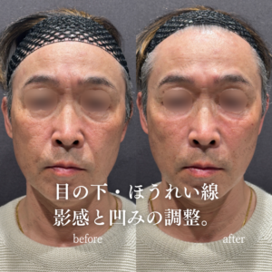 目の下・ほうれい線ヒアルロン酸症例写真の症例写真
