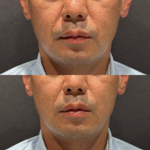 ほうれい線ヒアルロン酸ダイヤモンドフィール症例写真の症例写真