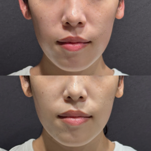 頬こけヒアルロン酸ボリフト症例写真の症例写真