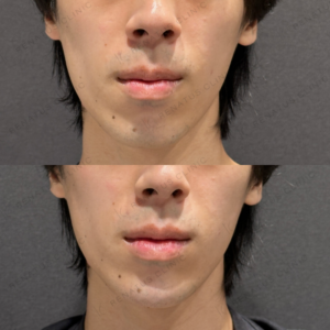 顎ヒアルロン酸ボラックス症例写真の症例写真