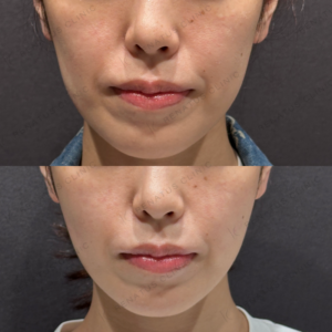 頬こけヒアルロン酸ボライト症例写真の症例写真