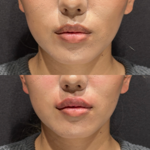 唇ヒアルロン酸ボルベラ症例写真の症例写真