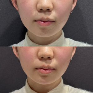 顎ヒアルロン酸ボラックス症例写真の症例写真