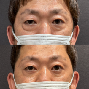 目の下のクマとり症例写真の症例写真