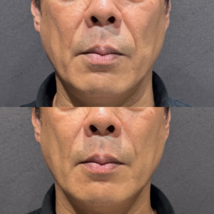 ほうれい線鼻翼基部ヒアルロン酸ボリューマボリフト症例写真の症例写真