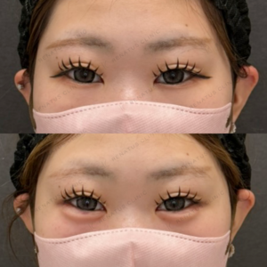 涙袋ヒアルロン酸ボルベラ症例写真の症例写真