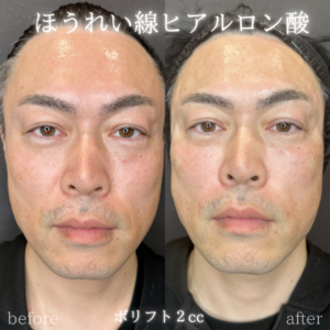 ほうれい線ヒアルロン酸ボリフト症例写真の症例写真