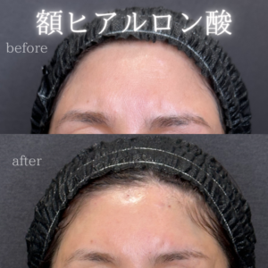 額ヒアルロン酸ボリューマ症例写真の症例写真