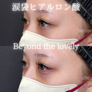 涙袋ヒアルロン酸で梅田・心斎橋からも人気殺到レナトゥスクリニックの症例写真