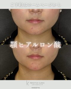 顎ヒアルロン酸名古屋安い上手いの症例写真