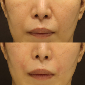 【新宿院|お試しヒアルロン酸1cc】ほうれい線ヒアルロン酸症例写真の症例写真