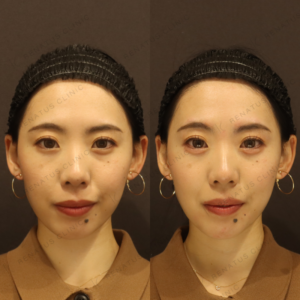 涙袋ヒアルロン酸ボルベラ症例写真|新宿で涙袋ヒアルロン酸の上手なクリニックの症例写真