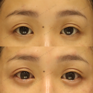 涙袋ヒアルロン酸ボルベラ症例写真の症例写真