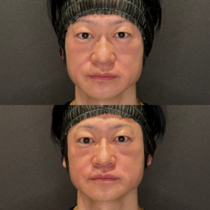 ほうれい線ヒアルロン酸症例写真｜レナトゥスクリニック　名古屋で上手いヒアルロン酸といえばの症例写真