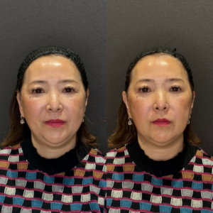 リフトアップヒアル症例写真｜レナトゥスクリニック　名古屋で安い上手いヒアルロン酸の症例写真