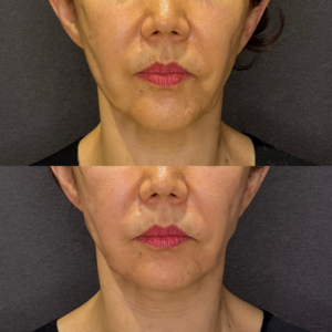 リフトアップヒアルロン酸｜レナトゥスクリニック　名古屋フィラーの名医の症例写真