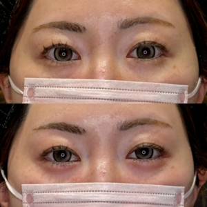 涙袋ヒアルロン酸症例写真｜レナトゥスクリニック　名古屋名駅で上手い安いヒアルロン酸の症例写真