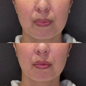 ほうれい線ヒアルロン酸症例写真｜レナトゥスクリニック　名古屋名駅から近いおすすめクリニックの症例写真