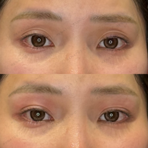 目の上ヒアルロン酸症例写真　窪み目治療ならレナトゥスクリニックの症例写真