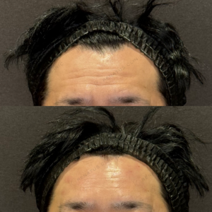 額ヒアルロン酸症例写真｜レナトゥスクリニック　名古屋名駅で上手い安いヒアルロン酸治療の症例写真