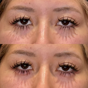 涙袋ヒアルロン酸症例写真　レナトゥスクリニック　名古屋ヒアルの名医の症例写真