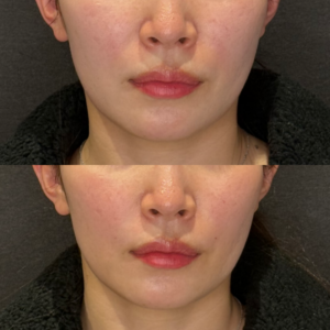 ほうれい線ヒアルロン酸症例写真｜レナトゥスクリニック　名古屋名駅で上手い安いヒアルロン酸の症例写真