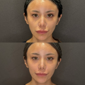 ほうれい線ヒアルロン酸症例写真｜レナトゥスクリニック　名古屋で上手い安いヒアルロン酸治療の症例写真