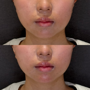 顎ヒアルロン酸症例写真｜レナトゥスクリニック　名古屋フィラーの名医の症例写真