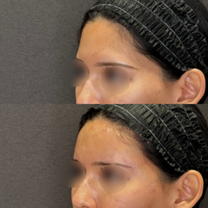 額・こめかみヒアルロン酸症例写真｜名古屋名駅のヒアル治療の症例写真