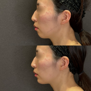 【Eライン形成】顎ヒアルロン酸症例写真　名古屋名駅のヒアル治療の症例写真