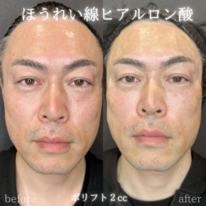 ほうれい線ヒアルロン酸ボリフト症例写真の症例写真