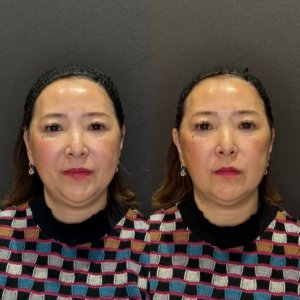 リフトアップヒアル症例写真｜レナトゥスクリニック　名古屋で安い上手いヒアルロン酸の症例写真