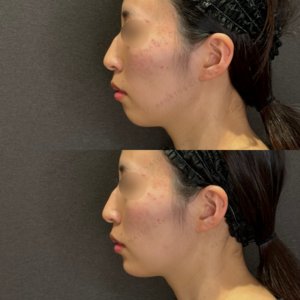 【Eライン形成】顎ヒアルロン酸症例写真　名古屋名駅のヒアル治療の症例写真