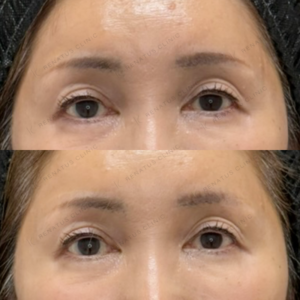 目の上ヒアルロン酸ボルベラ症例写真の症例写真