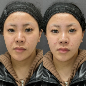 鼻翼基部・ほうれい線ヒアルロン酸ボリューマ・ボリフト症例写真の症例写真